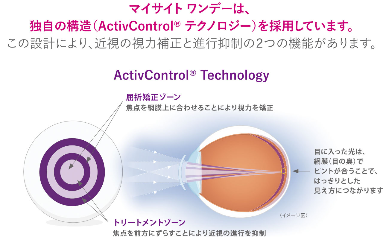 マイサイト ワンデーは、独自の構造(Activ Control R テクノロジー)を採用しています。
この設計により、近視の視力補正と進行抑制の2つの機能があります。