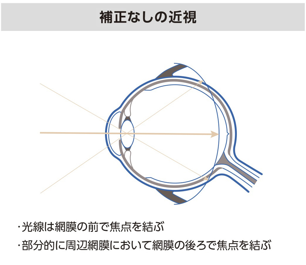 補正なしの近視
