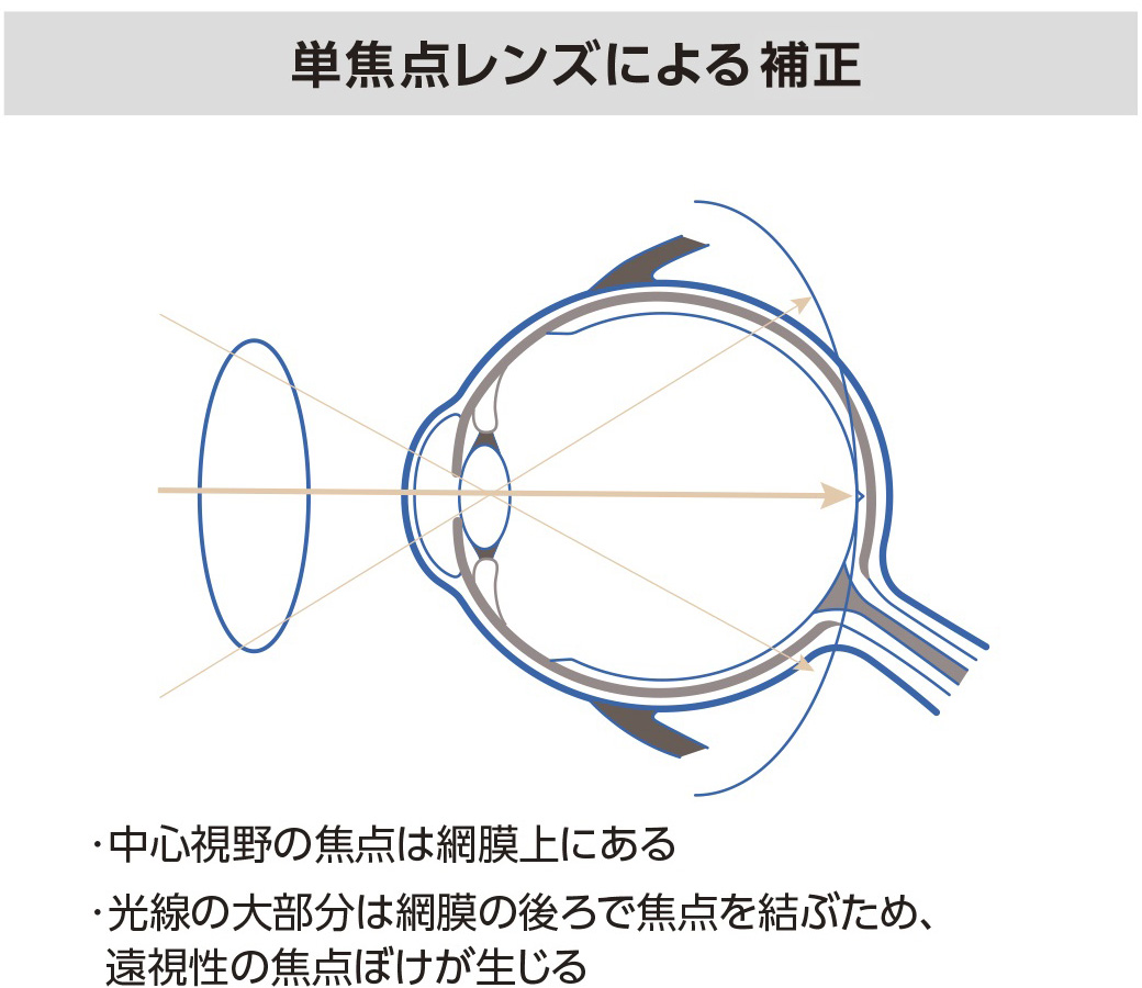 単焦点レンズによる補正