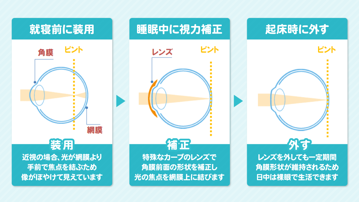オルソケラトロジーとは